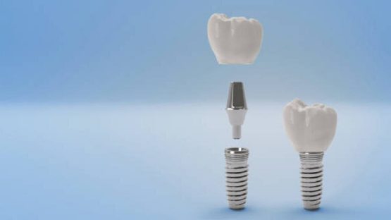 قیمت ایمپلنت اصفهان | بهترین ایمپلنت اصفهان | ایمپلنت دندان سوئیسی در اصفهان | اگر ایمپلنت نکنیم چه می شود؟