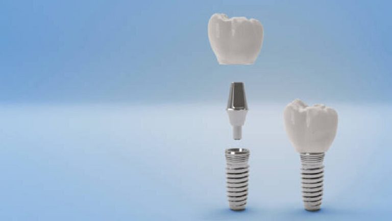 قیمت ایمپلنت اصفهان | بهترین ایمپلنت اصفهان | ایمپلنت دندان سوئیسی در اصفهان | اگر ایمپلنت نکنیم چه می شود؟