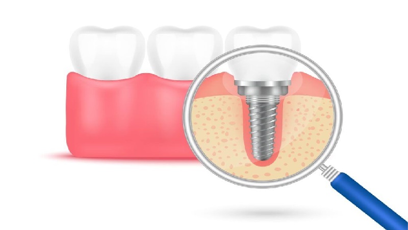 قیمت ایمپلنت اصفهان | بهترین ایمپلنت اصفهان | ایمپلنت دندان سوئیسی در اصفهان | حفظ سلامت ایمپلنت‌ ها با رعایت بهداشت دهان و دندان