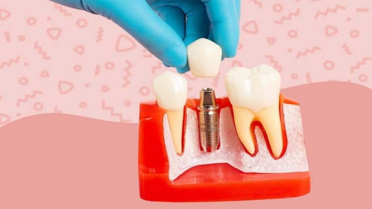 قیمت ایمپلنت اصفهان | بهترین ایمپلنت اصفهان | ایمپلنت دندان سوئیسی در اصفهان | فاصله زمانی مناسب بین کاشت ایمپلنت و نصب روکش ایمپلنت