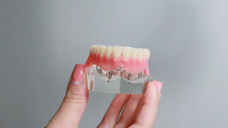 قیمت ایمپلنت اصفهان | بهترین ایمپلنت اصفهان | ایمپلنت دندان سوئیسی در اصفهان | قیمت ایمپلنت تمام دهان در اصفهان