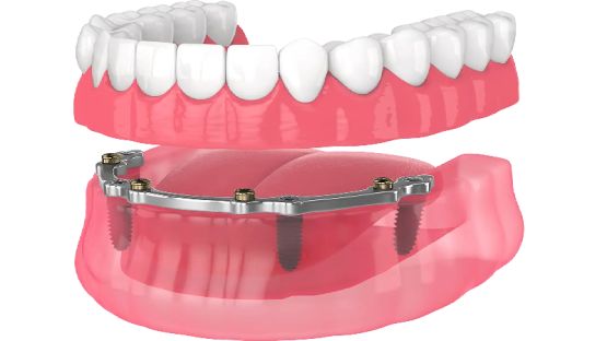 قیمت ایمپلنت اصفهان | بهترین ایمپلنت اصفهان | ایمپلنت دندان سوئیسی در اصفهان | هزینه درمان ایمپلنت اوردنچر در اصفهان