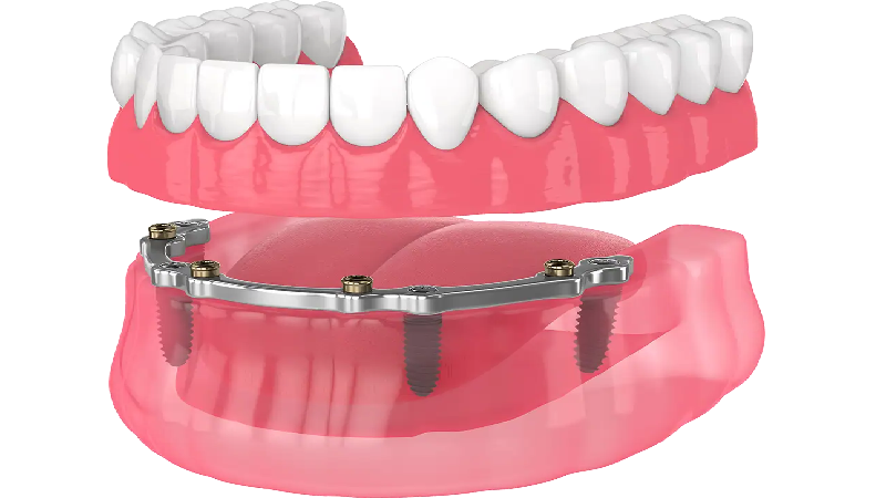 قیمت ایمپلنت اصفهان | بهترین ایمپلنت اصفهان | ایمپلنت دندان سوئیسی در اصفهان | هزینه درمان ایمپلنت اوردنچر در اصفهان