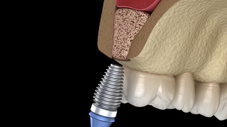 قیمت ایمپلنت اصفهان | بهترین ایمپلنت اصفهان | ایمپلنت دندان سوئیسی در اصفهان | چه عواملی بر هزینه جراحی سینوس لیفت تأثیر می‌گذارند؟