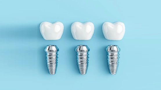 قیمت ایمپلنت اصفهان | بهترین ایمپلنت اصفهان | ایمپلنت دندان سوئیسی در اصفهان | کاربردهای اصلی روکش ایمپلنت