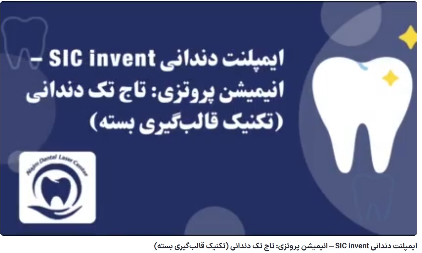 ایمپلنت دندانی SICvantage max: نوآوری مخروطی دکتر حسین برجیان،بهترین متخصص ایمپلنت اصفهان،تلفن تماس: 09138690321