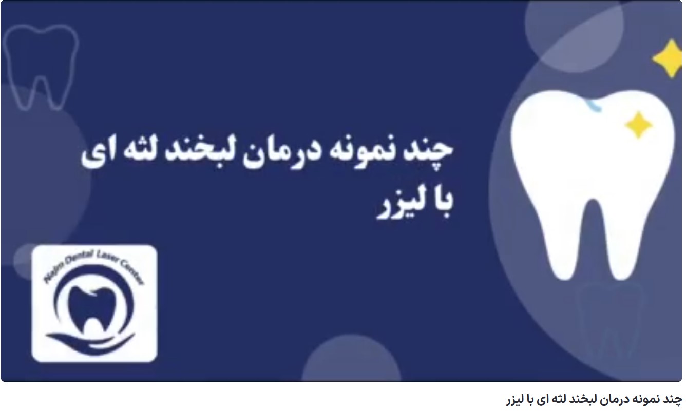 چند نمونه درمان لبخند لثه ای با لیزر دکتر حسین برجیان،بهترین متخصص ایمپلنت اصفهان،تلفن تماس: 09138690321