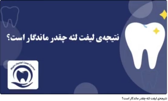 نتیجه‌ی لیفت لثه چقدر ماندگار است؟ دکتر حسین برجیان،بهترین متخصص ایمپلنت اصفهان،تلفن تماس: 09138690321