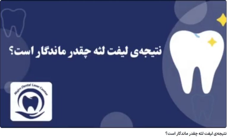 نتیجهی لیفت لثه چقدر ماندگار است؟ دکتر حسین برجیان،بهترین متخصص ایمپلنت اصفهان،تلفن تماس: 09138690321