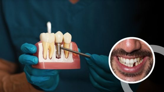 قیمت ایمپلنت اصفهان | بهترین ایمپلنت اصفهان | ایمپلنت دندان سوئیسی در اصفهان | چه زمانی از ایمپلنت تک دندانی استفاده می‌شود؟