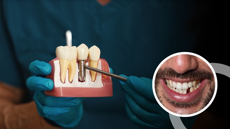 قیمت ایمپلنت اصفهان | بهترین ایمپلنت اصفهان | ایمپلنت دندان سوئیسی در اصفهان | چه زمانی از ایمپلنت تک دندانی استفاده می‌شود؟