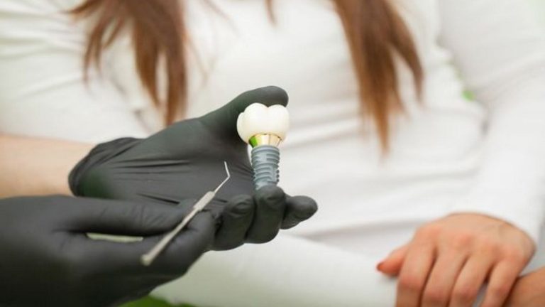 قیمت ایمپلنت اصفهان | بهترین ایمپلنت اصفهان | ایمپلنت دندان سوئیسی در اصفهان | کاشت ایمپلنت و انتخاب بهترین زمان ممکن