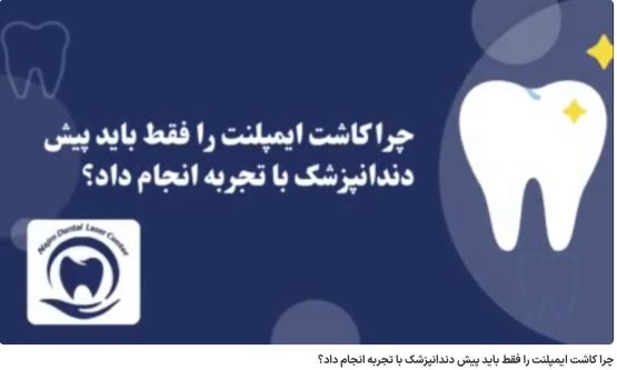 چرا کاشت ایمپلنت را فقط باید پیش دندانپزشک با تجربه انجام داد؟ دکتر حسین برجیان،بهترین متخصص ایمپلنت اصفهان،تلفن تماس: 09138690321