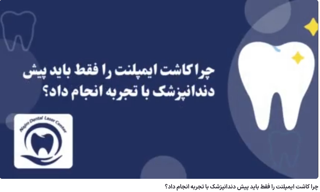چرا کاشت ایمپلنت را فقط باید پیش دندانپزشک با تجربه انجام داد؟ دکتر حسین برجیان،بهترین متخصص ایمپلنت اصفهان،تلفن تماس: 09138690321