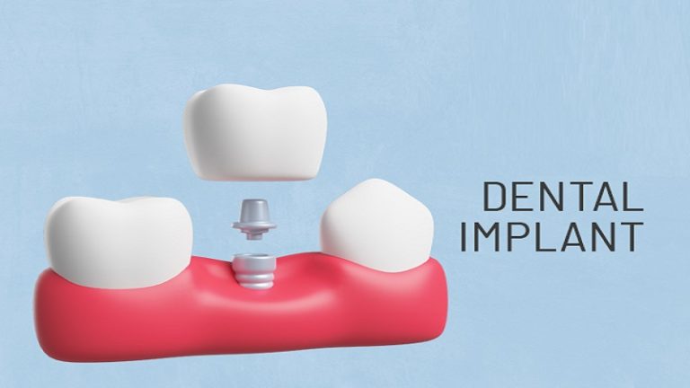 قیمت ایمپلنت اصفهان | بهترین ایمپلنت اصفهان | ایمپلنت دندان سوئیسی در اصفهان | تفاوت درمان ایمپلنت با کاشت دندان از انظار مختلف