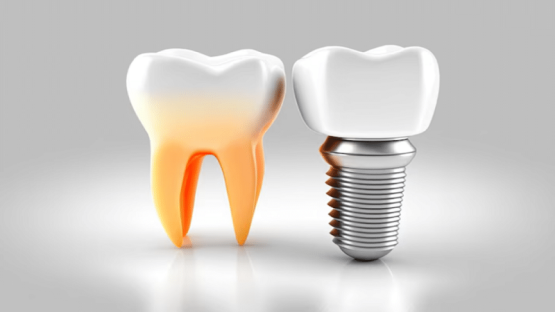 قیمت ایمپلنت اصفهان | بهترین ایمپلنت اصفهان | ایمپلنت دندان سوئیسی در اصفهان | درصد موفقیت بالای ایمپلنت در مرکز دکتر حسین برجیان