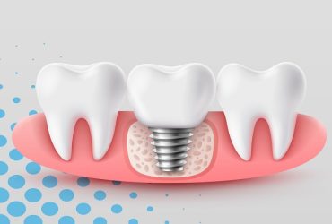 چرا قبل از ایمپلنت باید توسط دکتر برجیان مشاوره شوید؟