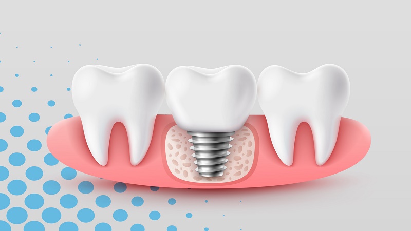 چرا قبل از ایمپلنت باید توسط دکتر برجیان مشاوره شوید؟