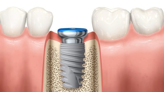قیمت ایمپلنت اصفهان | بهترین ایمپلنت اصفهان | ایمپلنت دندان سوئیسی در اصفهان | چرا کاشت ایمپلنت دندان را فقط باید پیش دندانپزشک با تجربه انجام داد؟