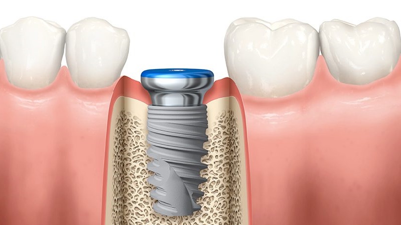 قیمت ایمپلنت اصفهان | بهترین ایمپلنت اصفهان | ایمپلنت دندان سوئیسی در اصفهان | چرا کاشت ایمپلنت دندان را فقط باید پیش دندانپزشک با تجربه انجام داد؟