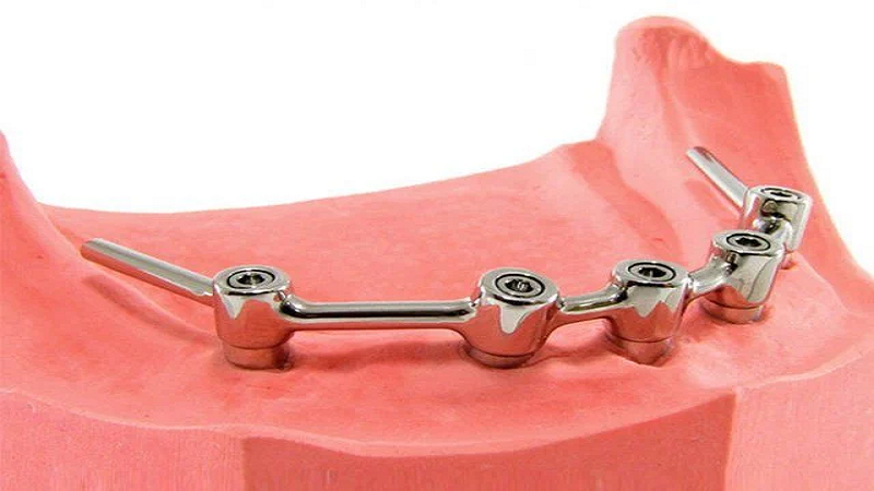 قیمت ایمپلنت اصفهان | بهترین ایمپلنت اصفهان | ایمپلنت دندان سوئیسی در اصفهان | اوردنچر میله‌ای جایگزینی بادوام، کاربردی و با ظاهر طبیعی