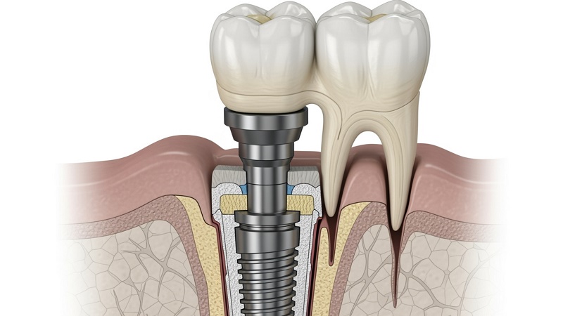 قیمت ایمپلنت اصفهان | بهترین ایمپلنت اصفهان | ایمپلنت دندان سوئیسی در اصفهان |   روکش کامپوزیتی (Composite Resin)