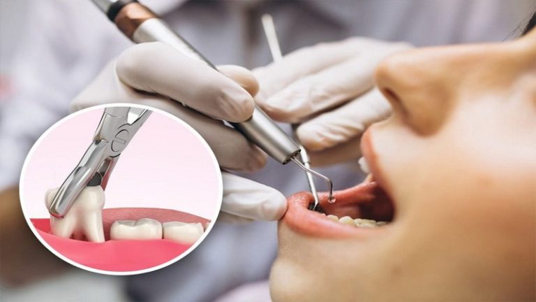 حفظ حفره دندان بعد از کشیدن برای ایمپلنت آینده